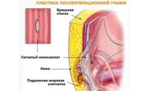 Послеоперационный фиброз брюшной стенки