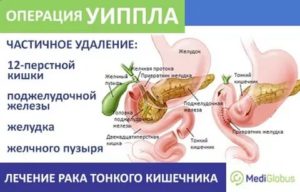 Операция 12 перстной кишки удалили часть кишечника