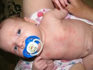Аллергия у ребенка только между ножек