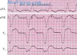 Ускоренная AV проводимость у беременных