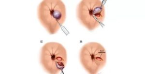 Жировик возле ануса