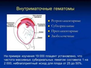 Приём транексана при ретрохориальной гематоме