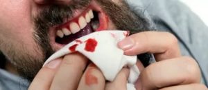 Кровоточивость на месте разрушенного зуба