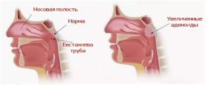 Аденоиды и заложенность носа