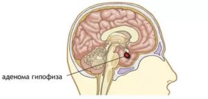 Аденома гипофиза при повышенном Пролактине головные боли мучают