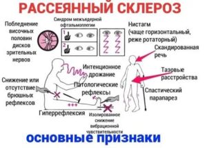 Невроз или возможно симптом рассеянного склероза