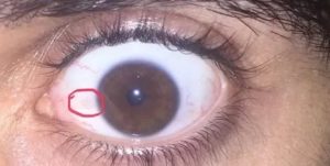 Красные глаза после снятия линз