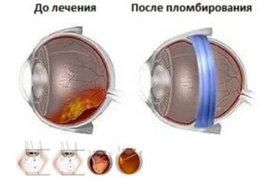 Сетчатка не прилегает плотно после пломбирования