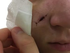 Рана после удаления ячменя