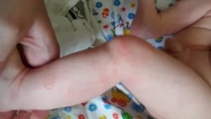 Сыпь на коленке у ребенка