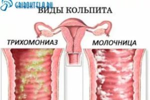 Молочница, Трихомониаз, или что?