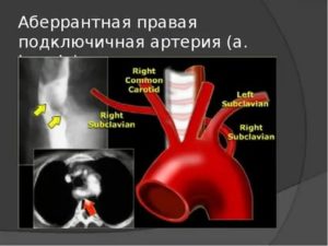Правая абберантная подключичная артерия