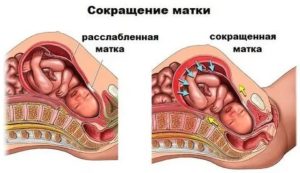 Тонус матки на 4 месяце