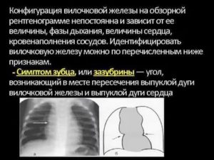 Сделали рентген грудной клетки и обнаружили увеличение вилочковой железы