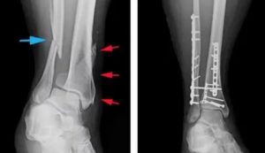 Онемение после перелома большой берцовой кости ноги