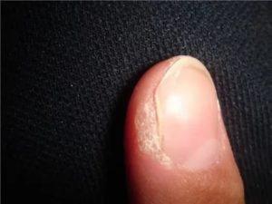 Мозоль на конце пальца под ногтем