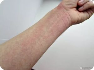 Аллергия на анальгин