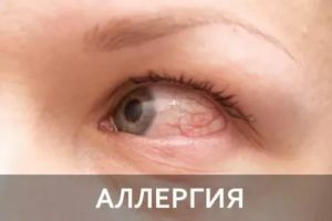 Красные глаза после снятия линз