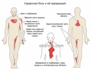 Боли в районе сердца при поднятии руки