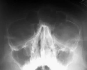 Рентген околоносовых пазух