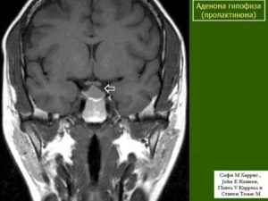 Пролактин и опухоли гипофиза