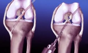 Осложнения после пластики пкс коленного сустава