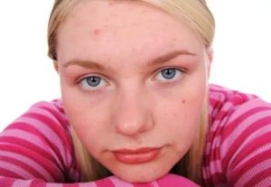 Сыпь на лице у девочки 14 лет