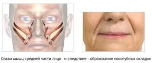 Спазм лицевой мышцы