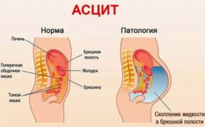 Жидкость в брюшной полости