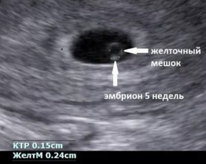 На 24 дпп нет эмбриона и желточного мешочка