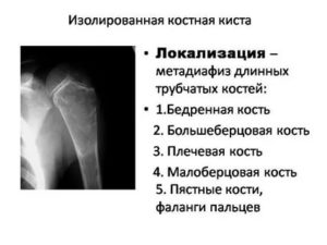 Уплотнение, склероз б/бугорка головки плечевой кости