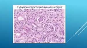 Тубулоинтерстициальный нефрит?