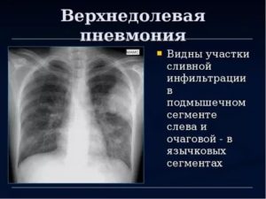 Верхнедолевая пневмония