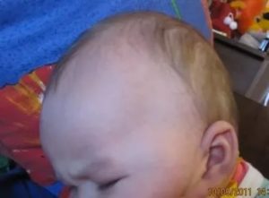 Шишка выпячивает над родничком