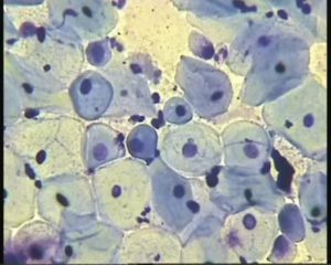 Мазок на цитологию, клетки плоского эпителия