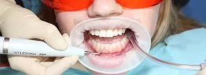 Сильные боли после снятия зубного камня