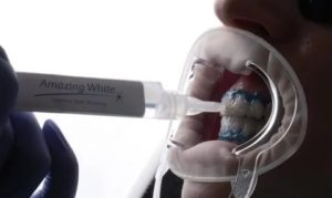 Отбеливание зубов методом Amazing White во время грудного вскармливания