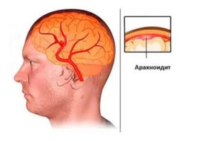 Киста в голове, сильные боли