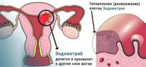 Тонкий эндометрий и Эко