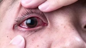 Щелчки или треск в глазах и глазнице