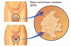 Нарост около клитора