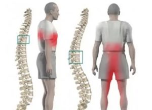 Боль при протрузии реберной дуги
