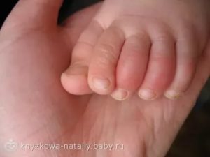 Опухший пальчик на ноге у ребенка