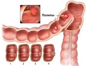 Удаление полипа толстой кишки