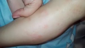 Сыпь на коже у ребёнка 9 месяцев