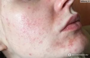 Сыпь после пилинга на лице