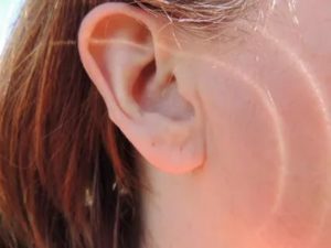 Складка на мочке уха