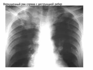 Опухоль 6 ребра слева