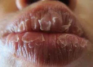 Сильная Сухость половых губ