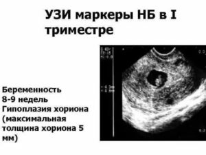 Тонкий хорион. Тенденция к гипоплазии хориона